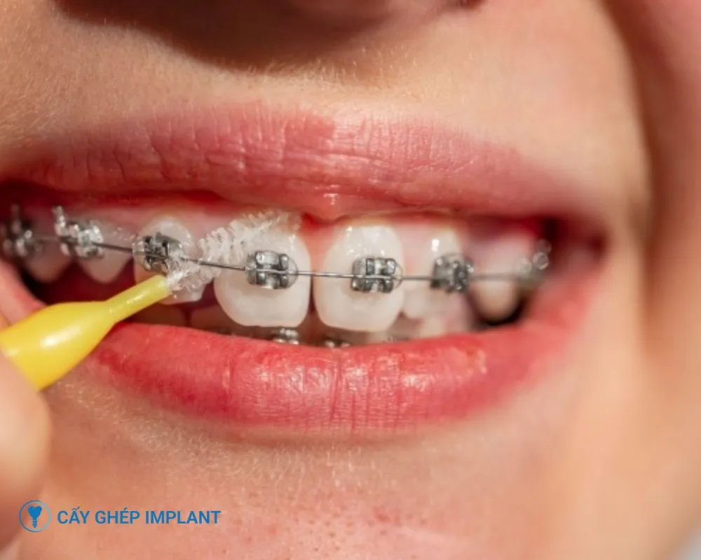 trồng răng implant có niềng răng được không