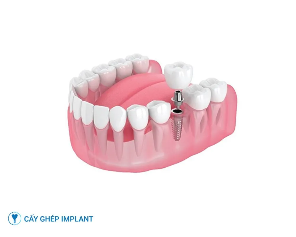 trồng răng implant có tốt không