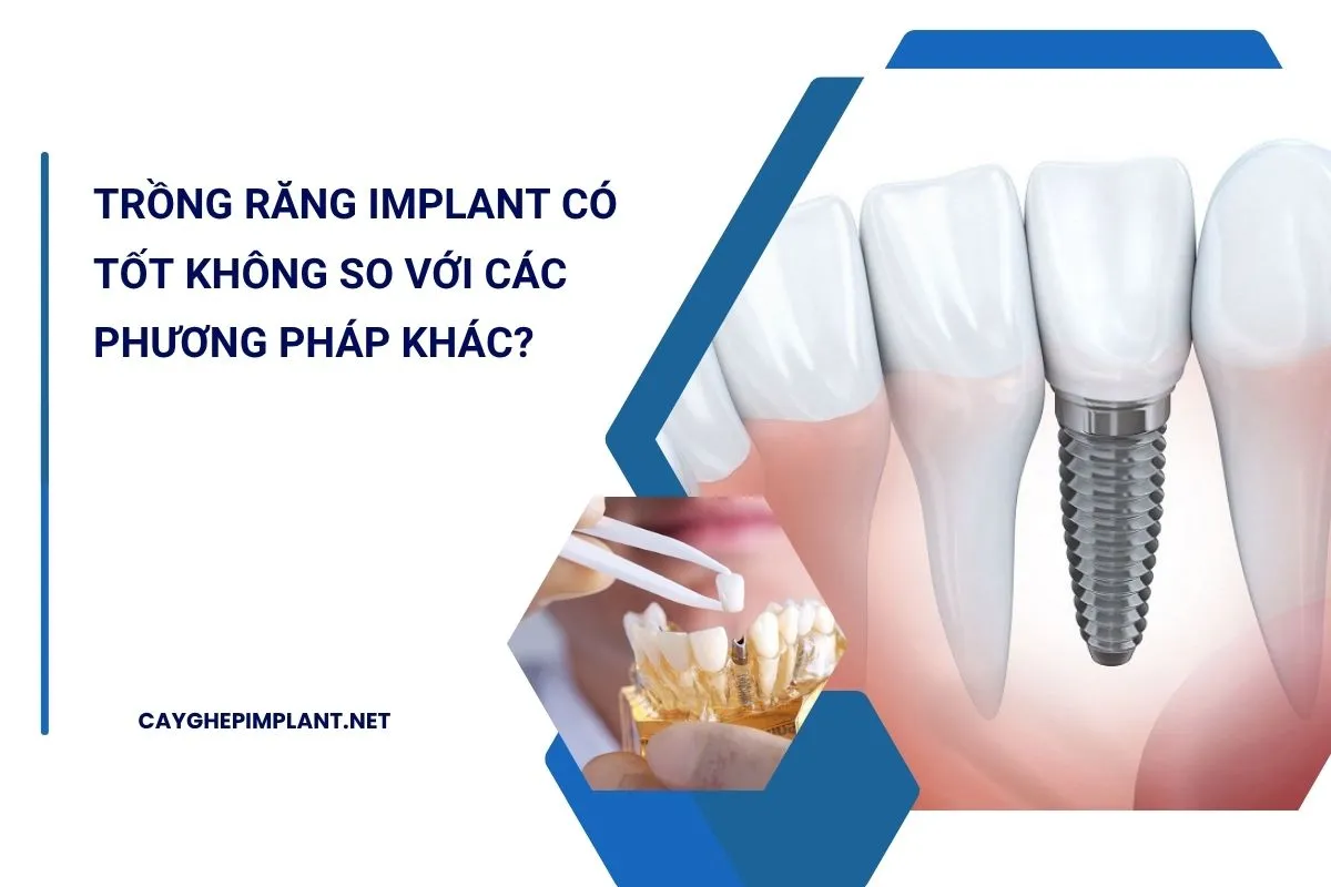 trồng răng implant có tốt không