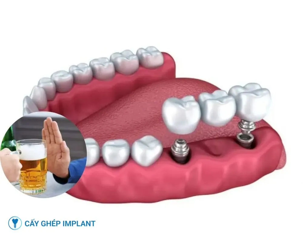 trồng răng implant có uống bia được không