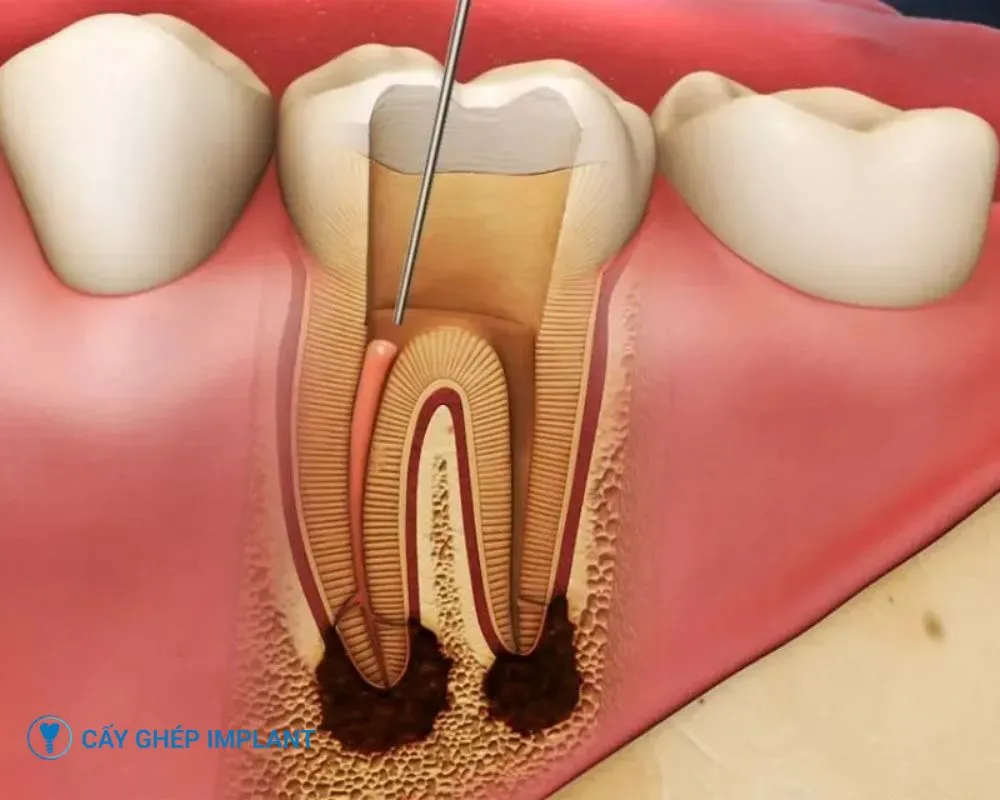 trồng răng implant có uống bia được không