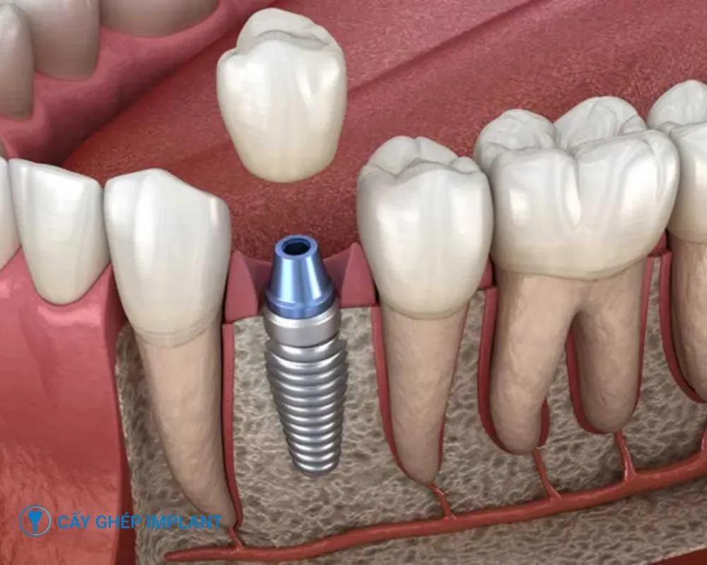 trồng răng implant có uống bia được không