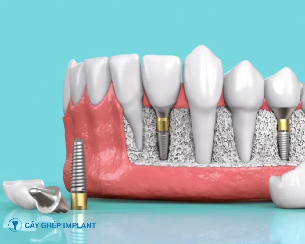 trồng răng implant có vĩnh viễn không