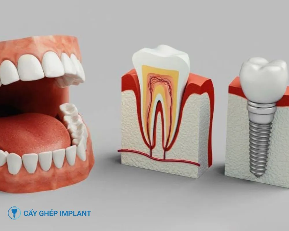 trồng răng implant có vĩnh viễn không