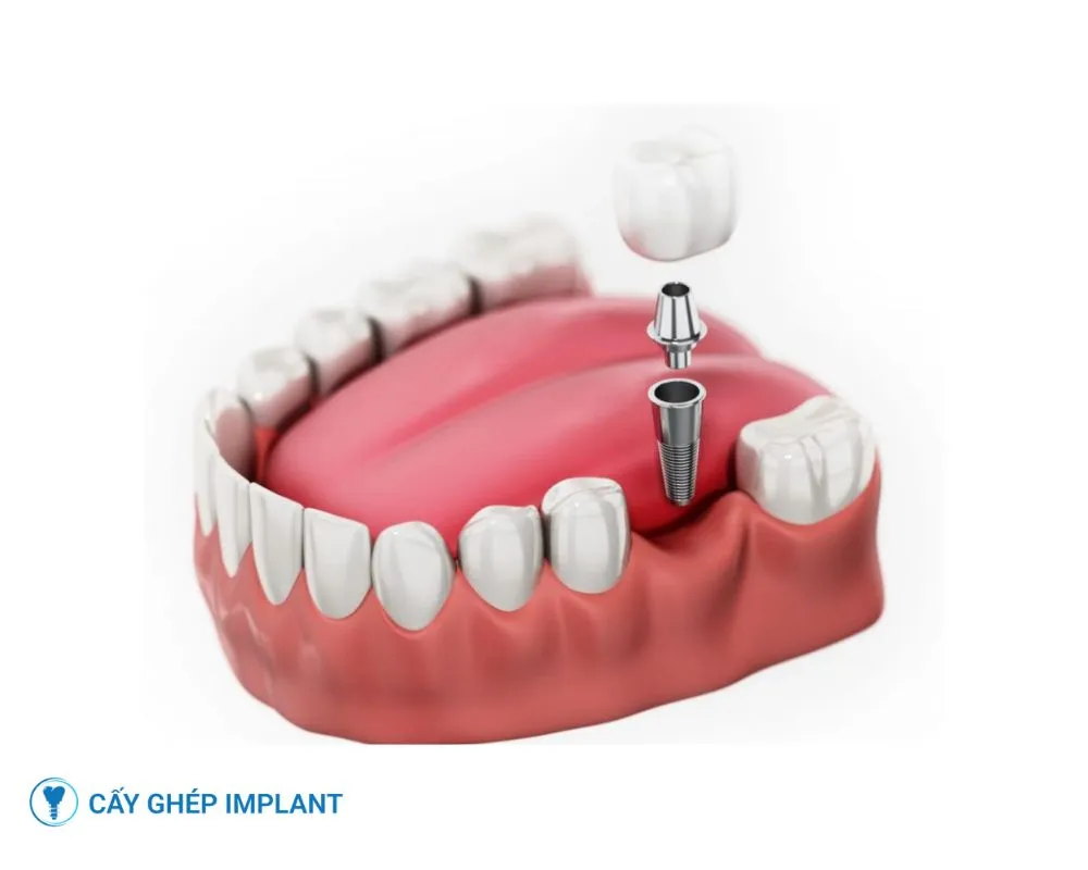 trồng răng implant có vĩnh viễn không