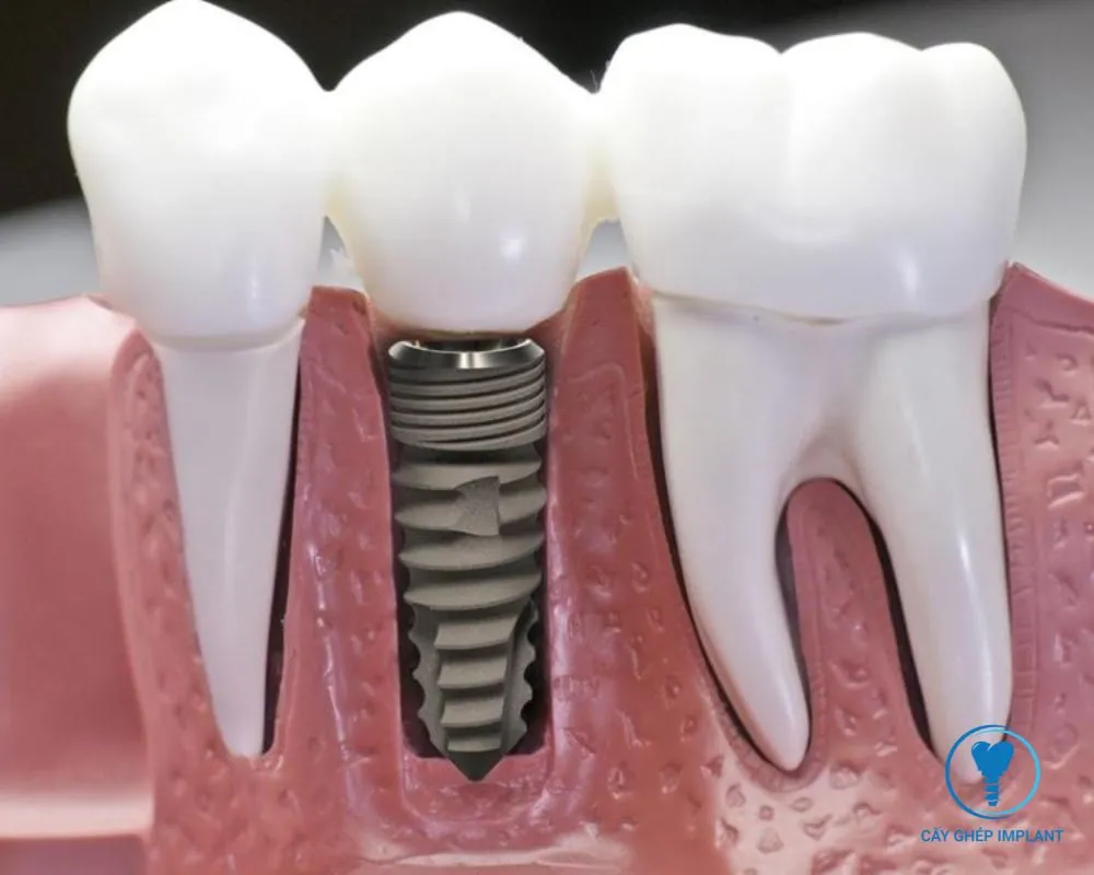 trồng răng implant hàn quốc giá bao nhiêu