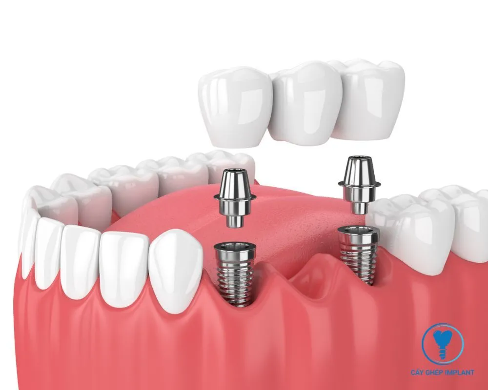 trồng răng implant hàn quốc giá bao nhiêu