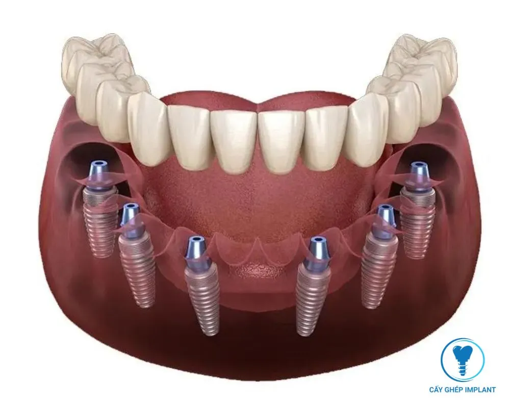 trồng răng implant hàn quốc giá bao nhiêu