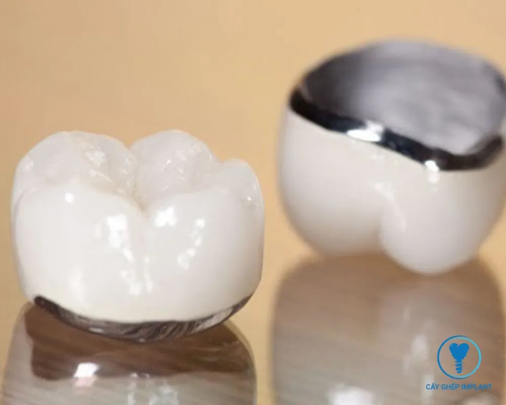 trồng răng implant hàn quốc giá bao nhiêu