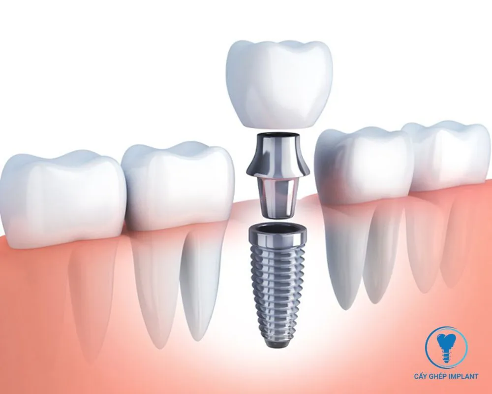 trồng răng implant không đau