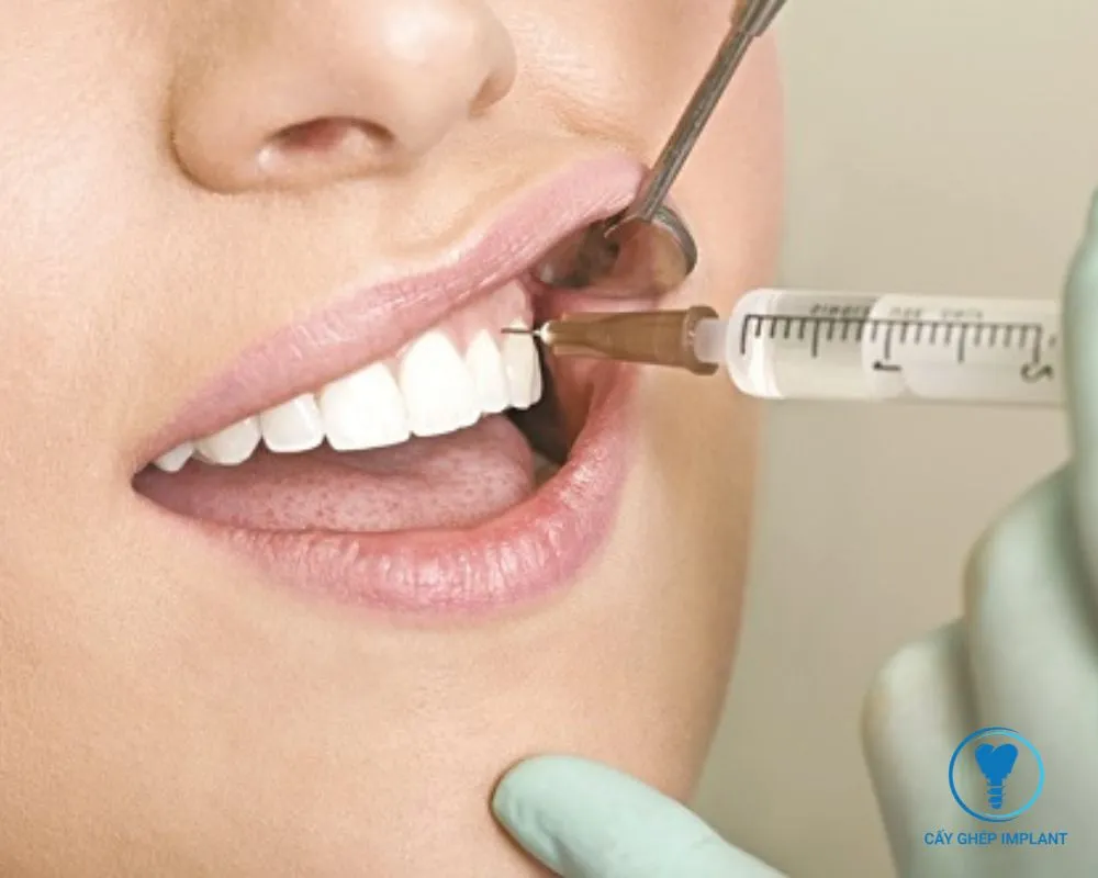 trồng răng implant không đau