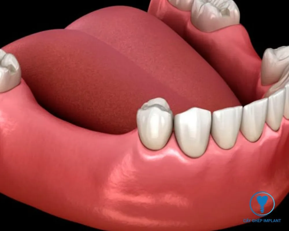 trụ implant biotem hàn quốc