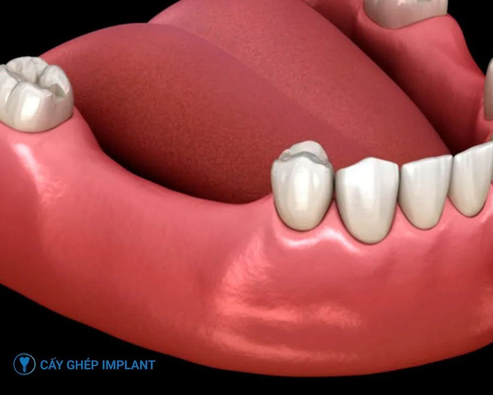 trụ implant thụy sĩ