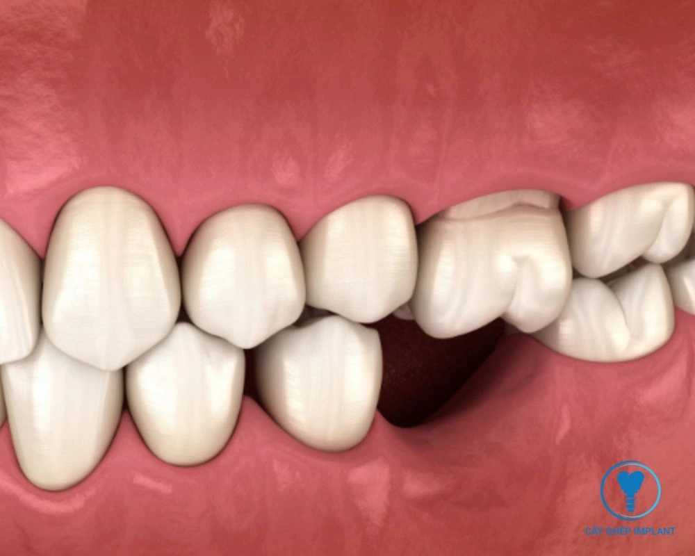 cấy implant răng số 6 bao nhiêu tiền
