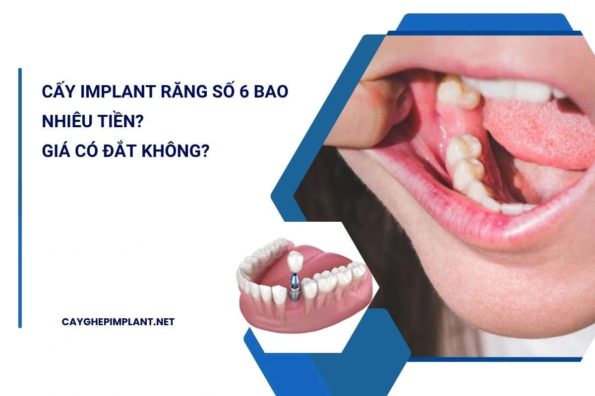 cấy implant răng số 6 bao nhiêu tiền