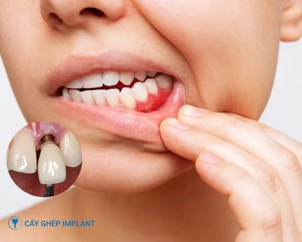 trồng răng implant bị tiêu xương