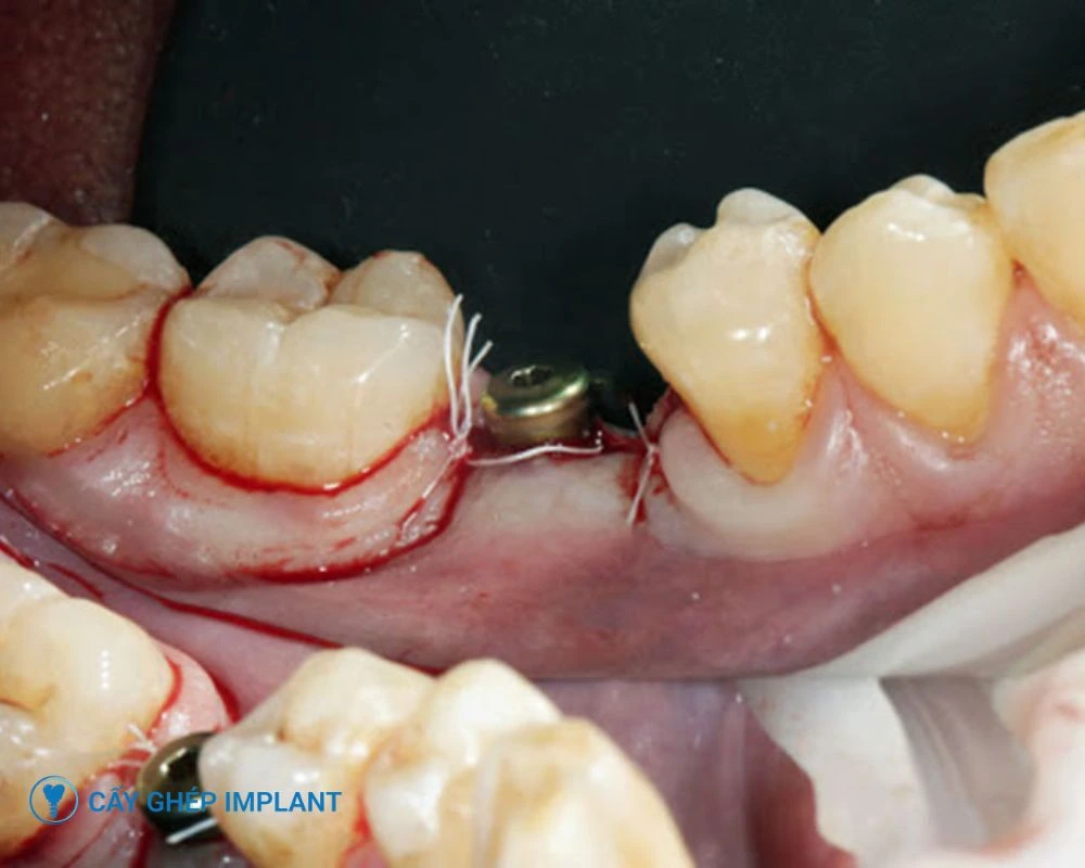 trồng răng implant bị tiêu xương