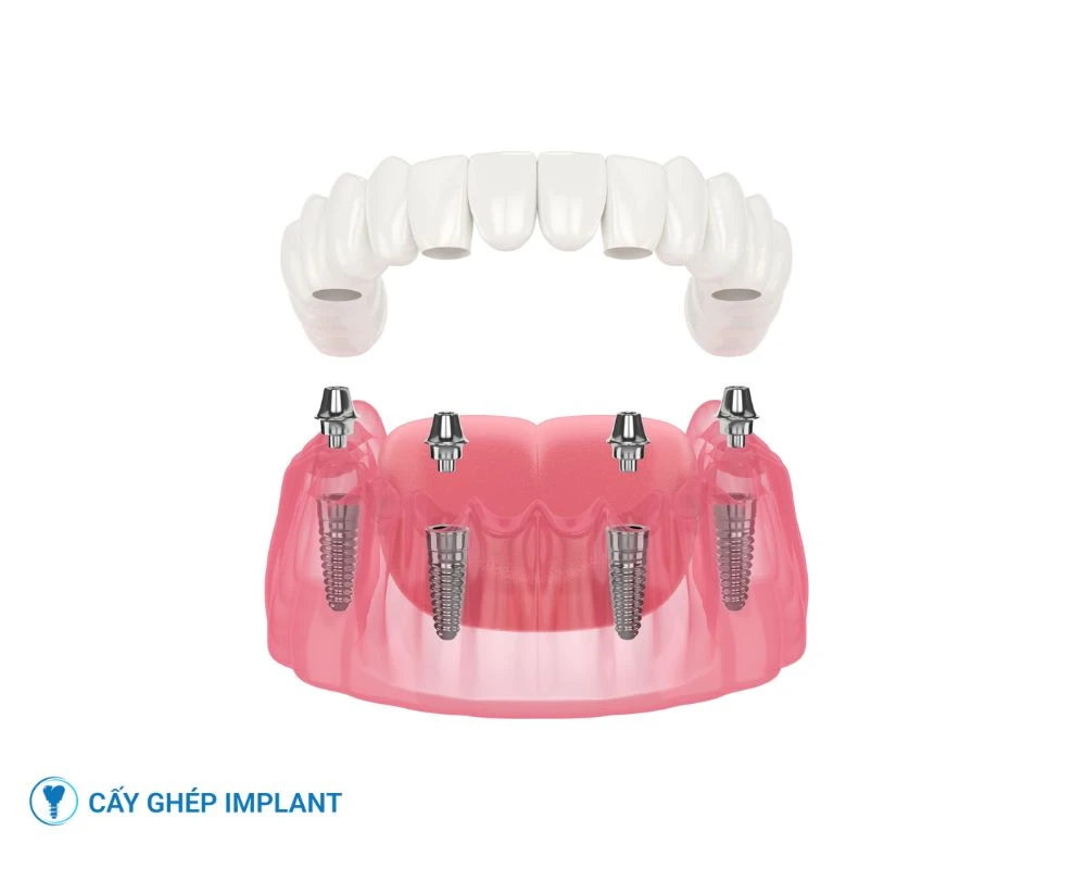 trồng răng implant nguyên hàm