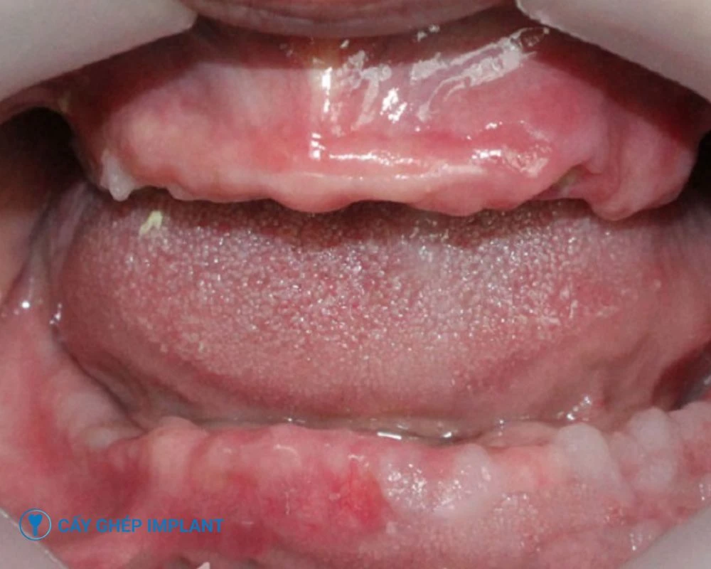 trồng răng implant nguyên hàm