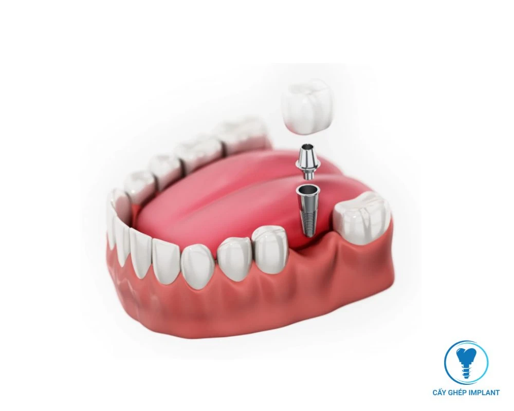 trụ implant mỹ