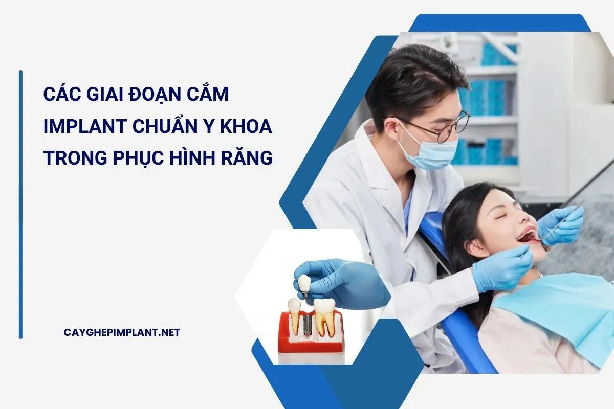các giai đoạn cắm implant