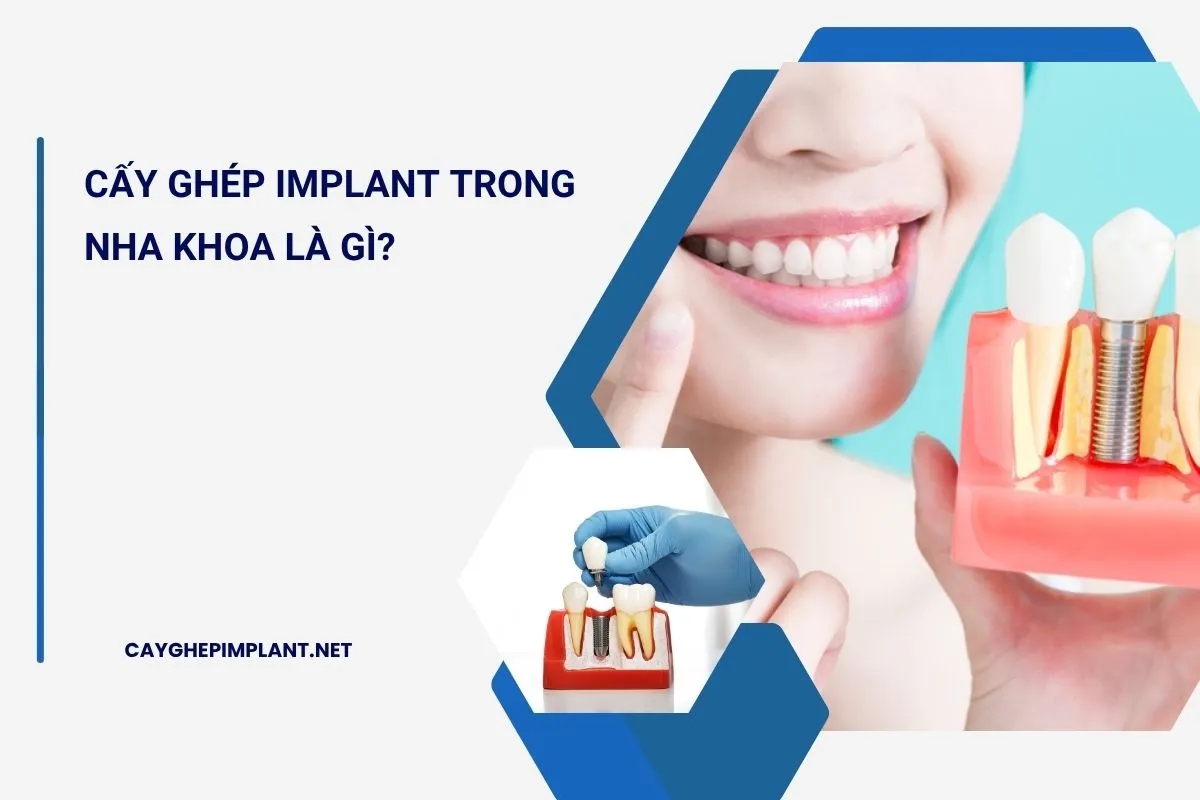 cấy ghép implant trong nha khoa là gì
