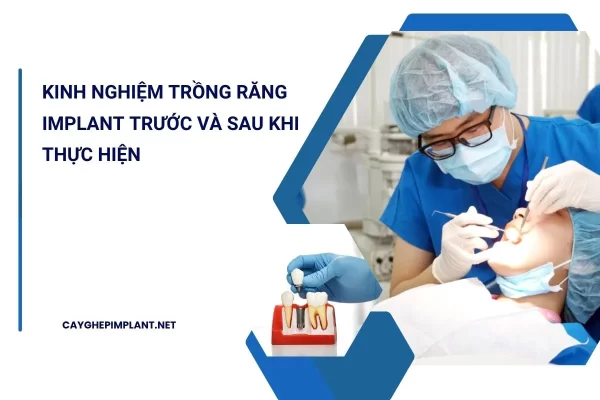 kinh nghiệm trồng răng implant