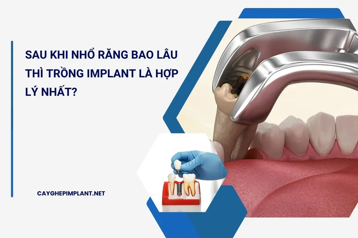 sau khi nhổ răng bao lâu thì trồng implant