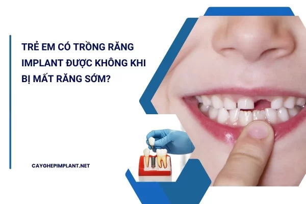 trẻ em có trồng răng implant được không