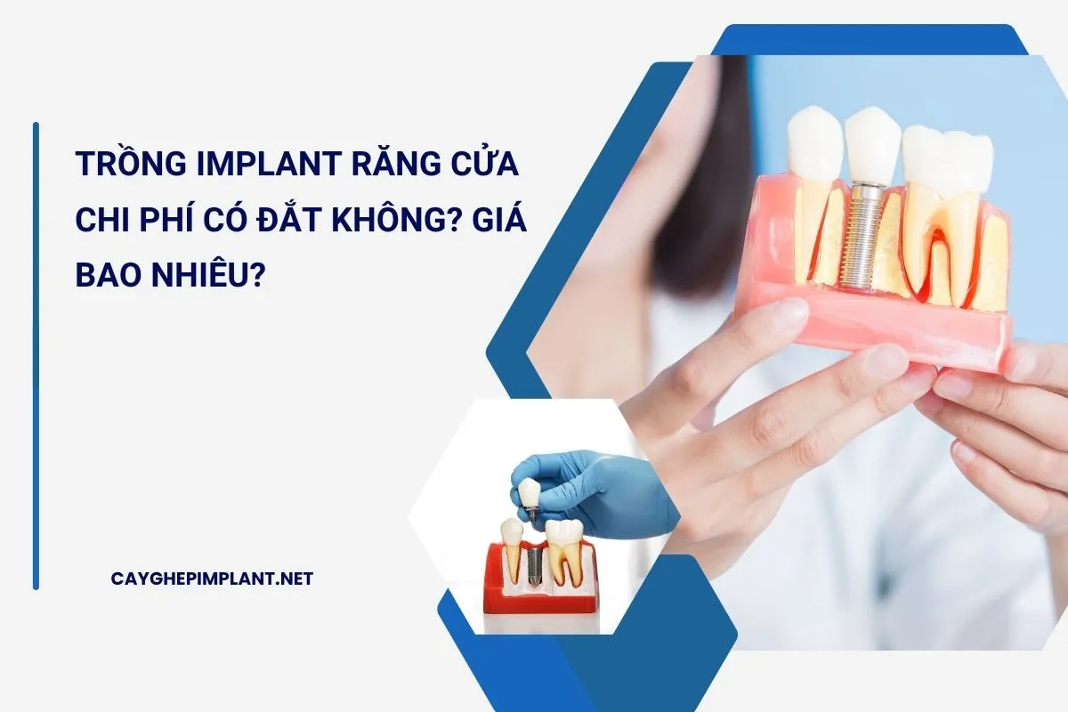 trồng implant răng cửa