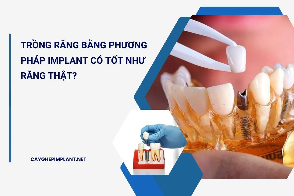 trồng răng bằng phương pháp implant