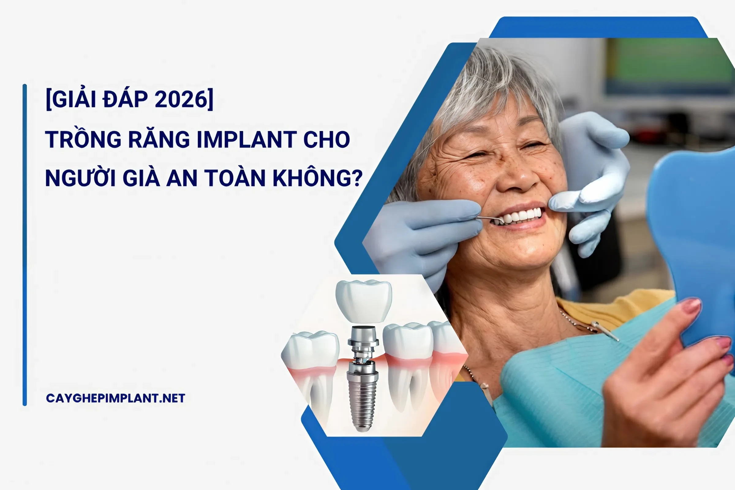 trồng răng implant cho người già