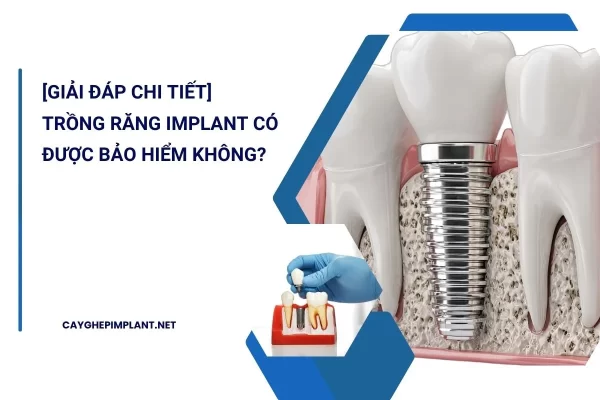 trồng răng implant có được bảo hiểm không