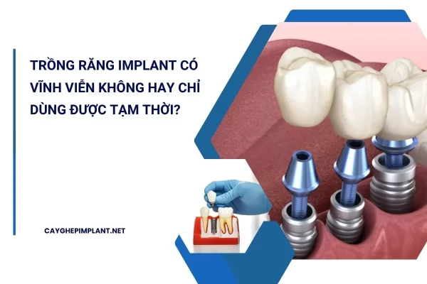 trồng răng implant có vĩnh viễn không