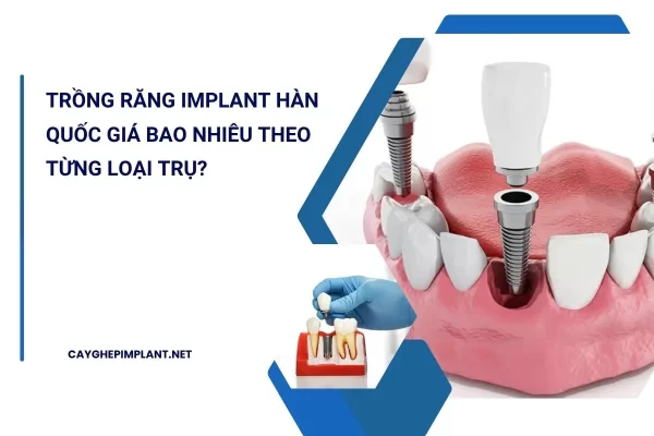 trồng răng implant hàn quốc giá bao nhiêu