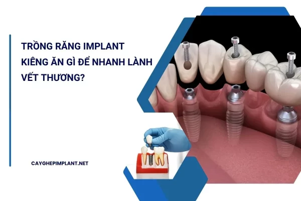 trồng răng implant kiêng ăn gì