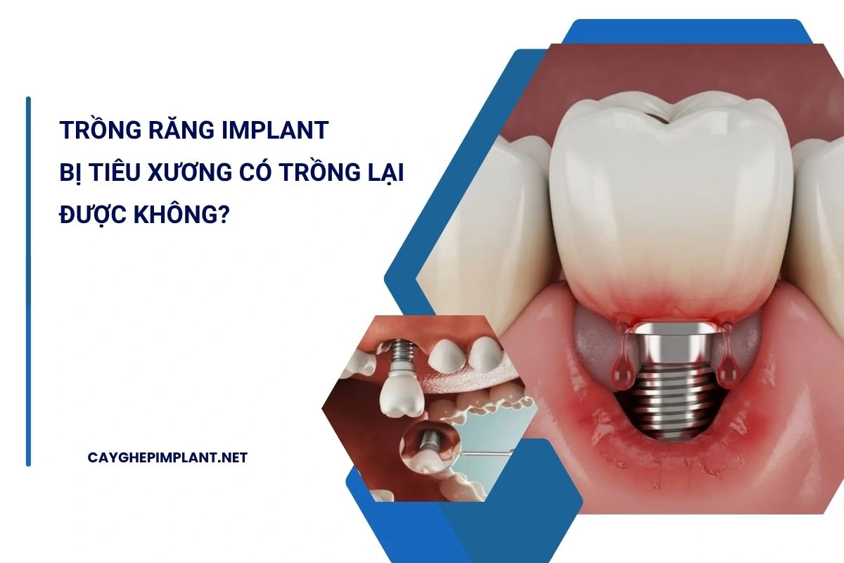 trồng răng implant bị tiêu xương
