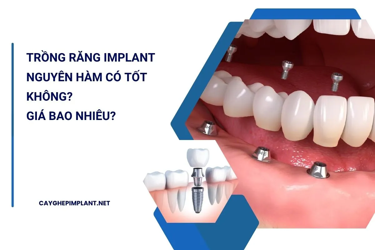trồng răng implant nguyên hàm