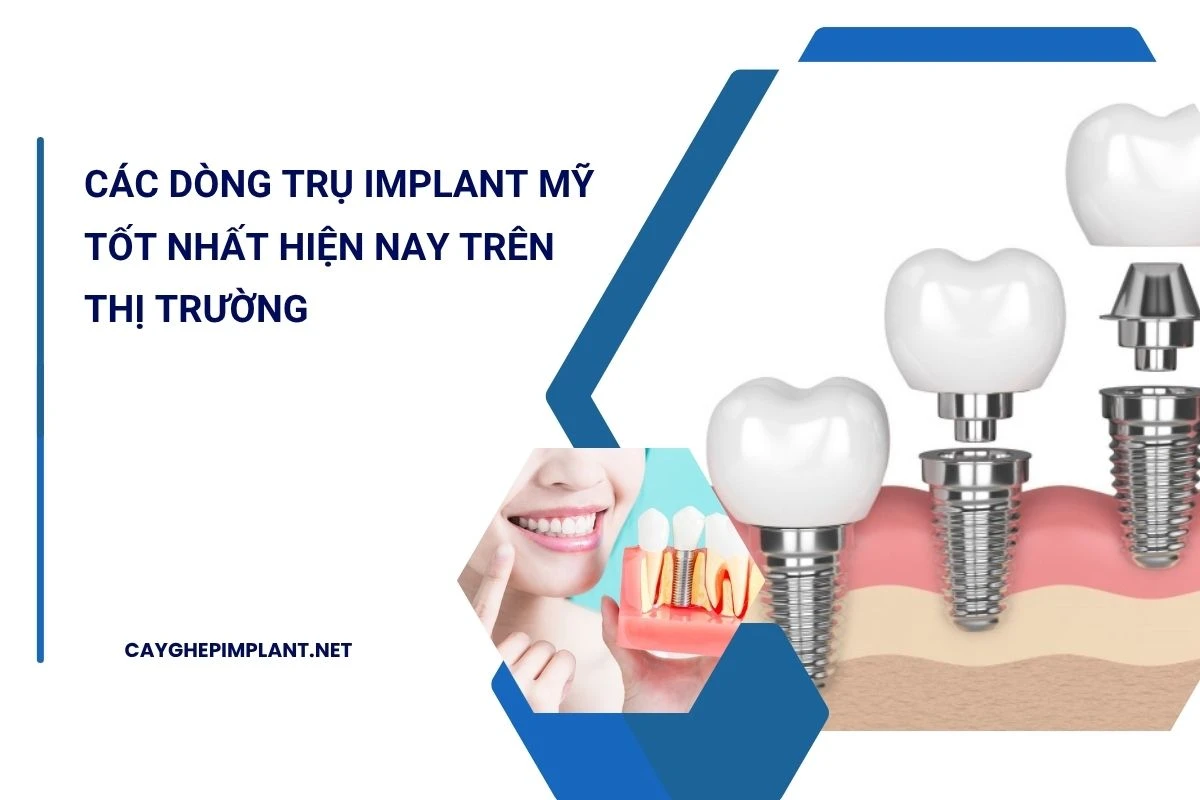 trụ implant mỹ